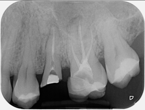 Molar endodontics - Pre-op case 3
